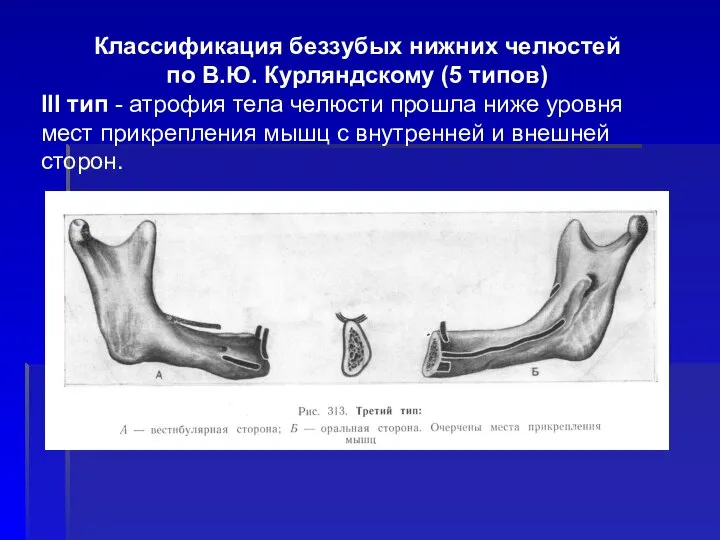 Классификация беззубых нижних челюстей по В.Ю. Курляндскому (5 типов) III тип