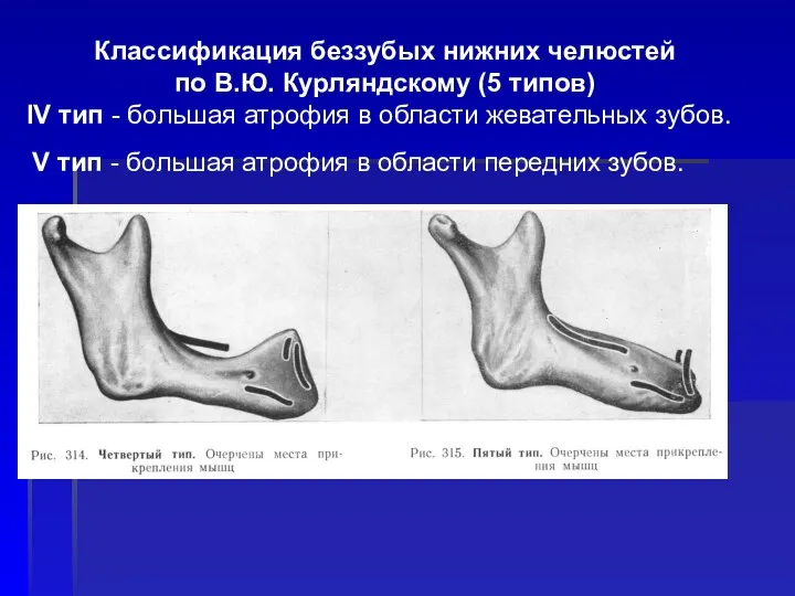 Классификация беззубых нижних челюстей по В.Ю. Курляндскому (5 типов) IV тип