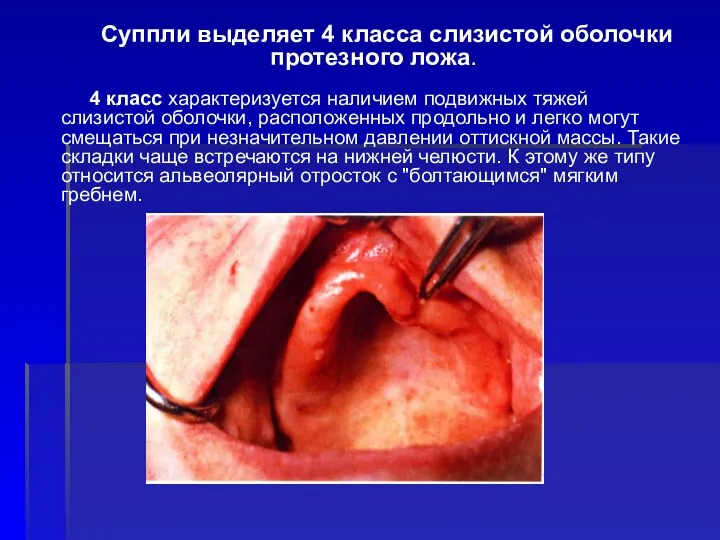 Суппли выделяет 4 класса слизистой оболочки протезного ложа. 4 класс характеризуется