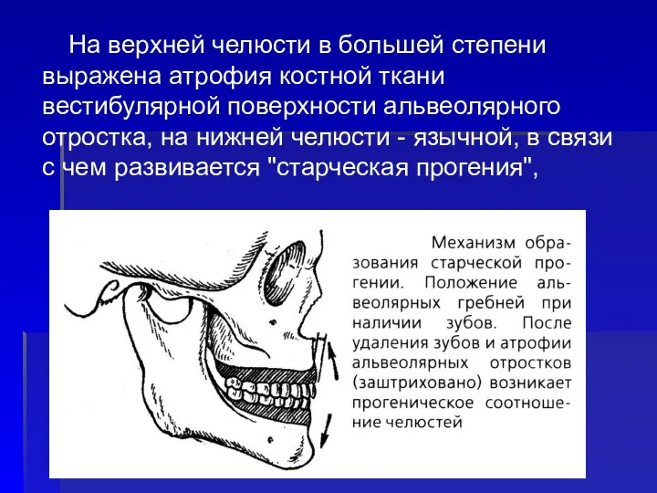 На верхней челюсти в большей степени выражена атрофия костной ткани вестибулярной