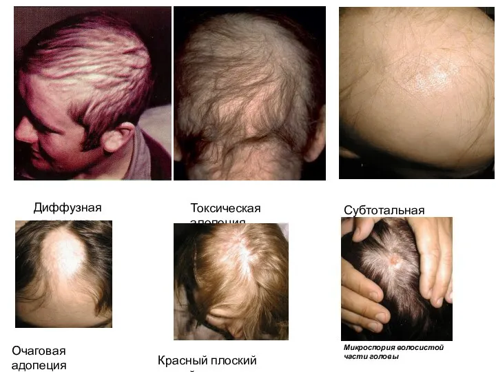 Диффузная алопеция Токсическая алопеция Субтотальная алопеция Очаговая адопеция Красный плоский лишай Микроспория волосистой части головы