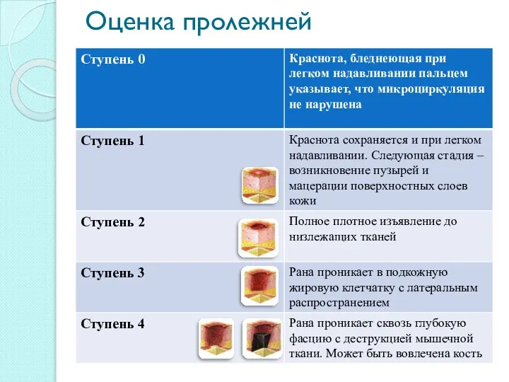 Оценка пролежней