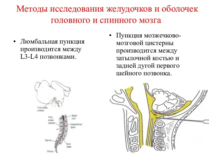 Методы исследования желудочков и оболочек головного и спинного мозга Люмбальная пункция