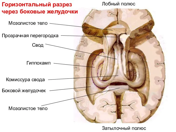 Горизонтальный разрез через боковые желудочки Гиппокамп Комиссура свода Свод Мозолистое тело