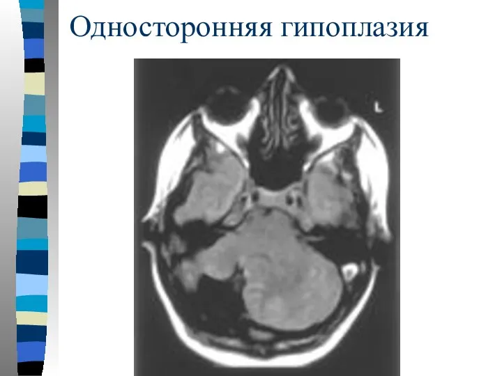 Односторонняя гипоплазия