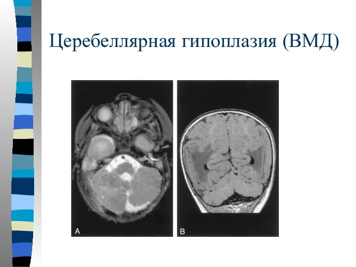 Церебеллярная гипоплазия (ВМД)