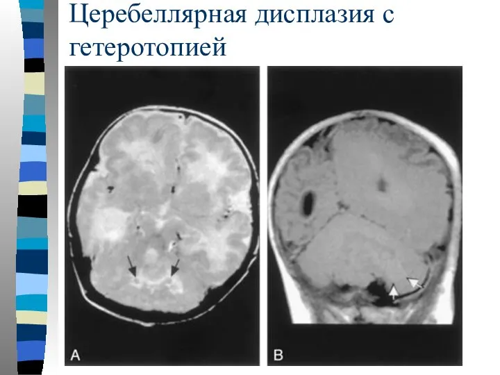 Церебеллярная дисплазия с гетеротопией