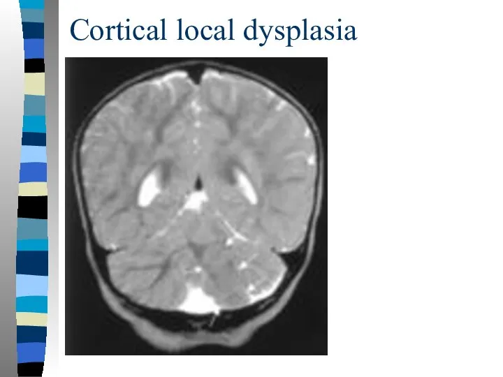 Cortical local dysplasia