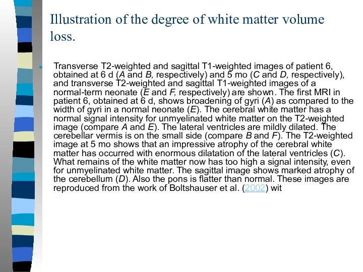 Illustration of the degree of white matter volume loss. Transverse T2-weighted