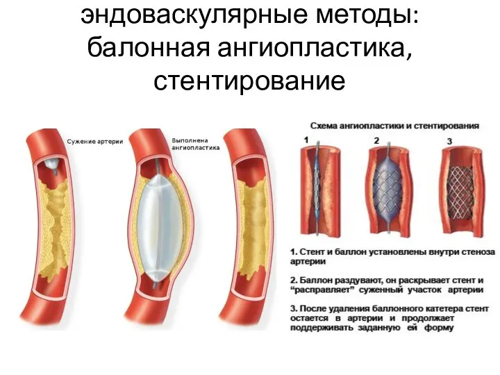 эндоваскулярные методы: балонная ангиопластика, стентирование