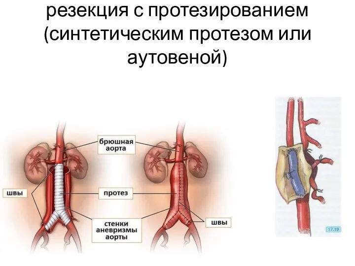 резекция с протезированием (синтетическим протезом или аутовеной)