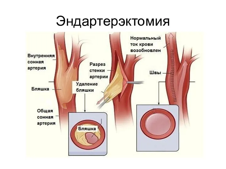 Эндартерэктомия