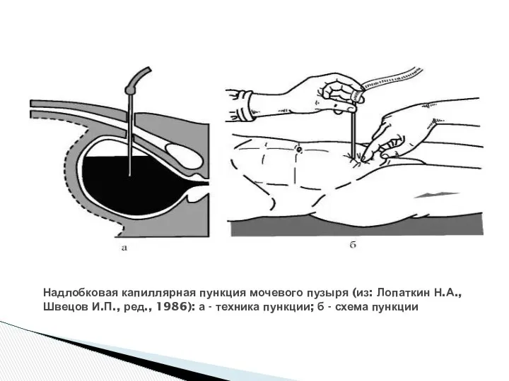 Надлобковая капиллярная пункция мочевого пузыря (из: Лопаткин Н.А., Швецов И.П., ред.,