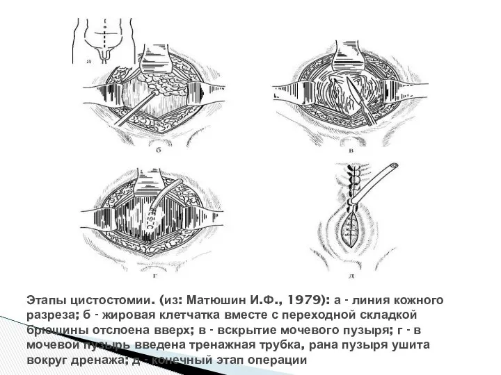 Этапы цистостомии. (из: Матюшин И.Ф., 1979): а - линия кожного разреза;