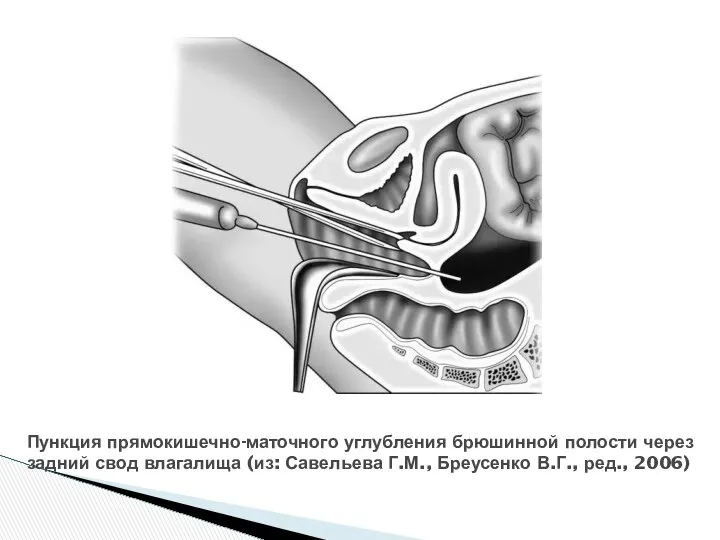 Пункция прямокишечно-маточного углубления брюшинной полости через задний свод влагалища (из: Савельева Г.М., Бреусенко В.Г., ред., 2006)