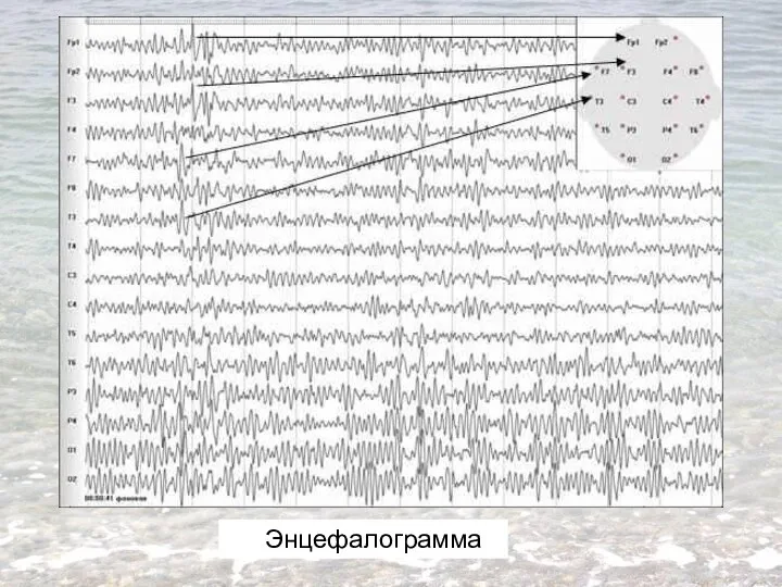 Энцефалограмма