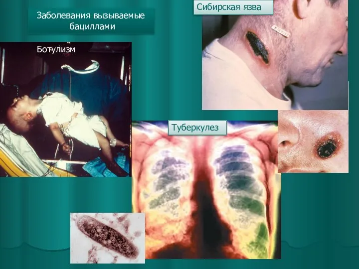Туберкулез Сибирская язва Ботулизм Заболевания вызываемые бациллами
