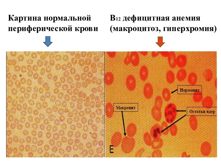 Картина нормальной периферической крови В12 дефицитная анемия (макроцитоз, гиперхромия)