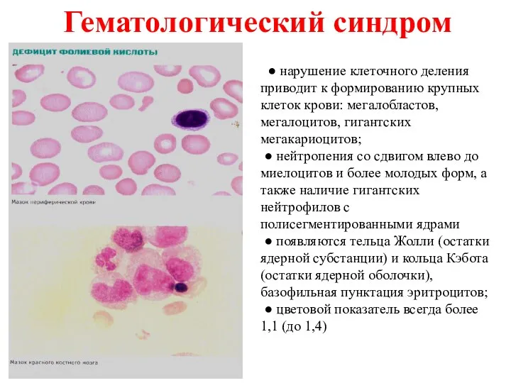 ● нарушение клеточного деления приводит к формированию крупных клеток крови: мегалобластов,