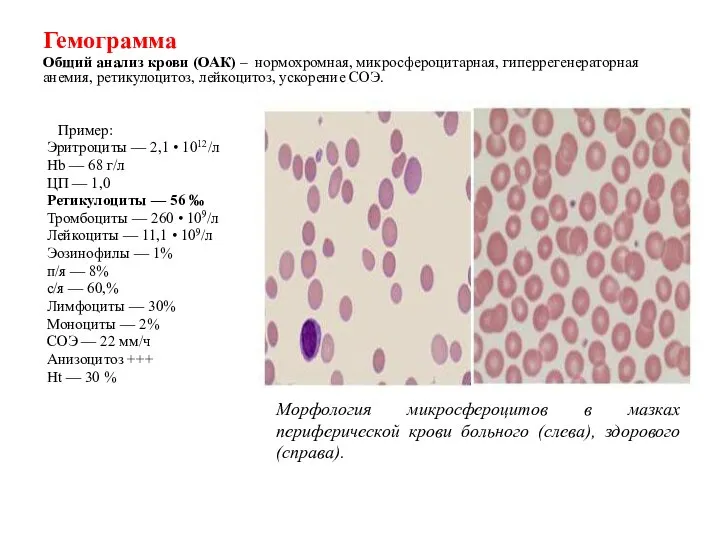 Гемограмма Общий анализ крови (ОАК) – нормохромная, микросфероцитарная, гиперрегенераторная анемия, ретикулоцитоз,