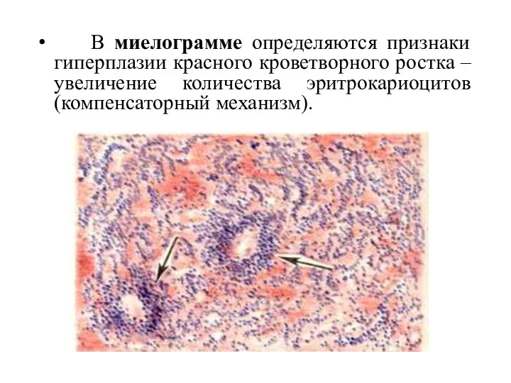 В миелограмме определяются признаки гиперплазии красного кроветворного ростка – увеличение количества эритрокариоцитов (компенсаторный механизм).