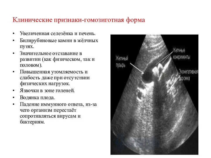 Клинические признаки-гомозиготная форма Увеличенная селезёнка и печень. Билирубиновые камни в жёлчных