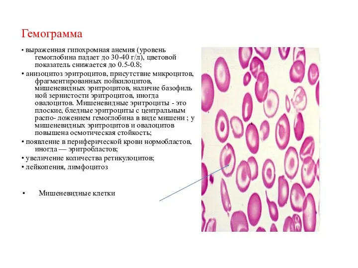 Гемограмма • выраженная гипохромная анемия (уровень гемоглобина падает до 30-40 г/л),