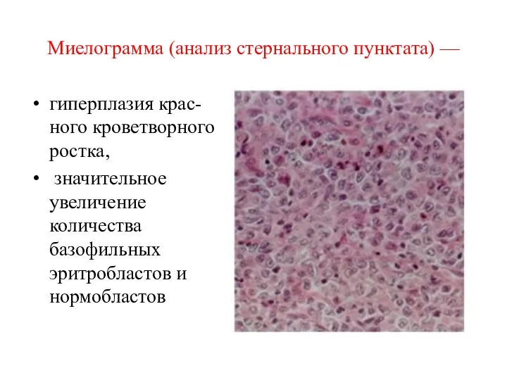 Миелограмма (анализ стернального пунктата) — гиперплазия крас- ного кроветворного ростка, значительное