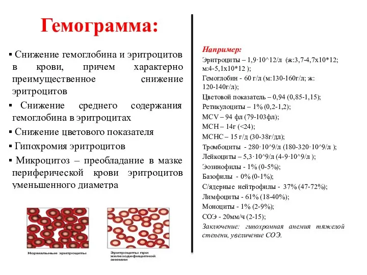 Гемограмма: Снижение гемоглобина и эритроцитов в крови, причем характерно преимущественное снижение