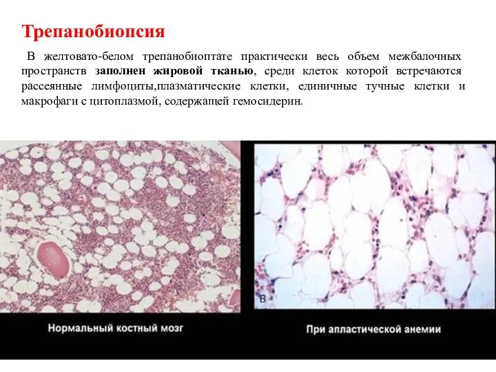 Трепанобиопсия В желтовато-белом трепанобиоптате практически весь объем межбалочных пространств заполнен жировой