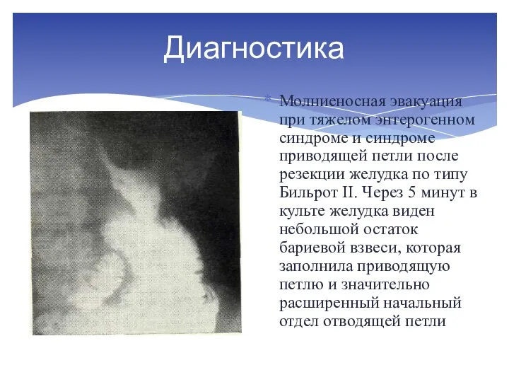 Диагностика Молниеносная эвакуация при тяжелом энтерогенном синдроме и синдроме приводящей петли