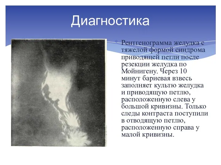 Диагностика Рентгенограмма же­лудка с тяжелой формой синдрома приводящей петли после резекции