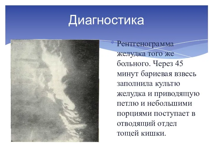 Диагностика Рентгенограмма желудка того же больного. Через 45 минут бариевая взвесь