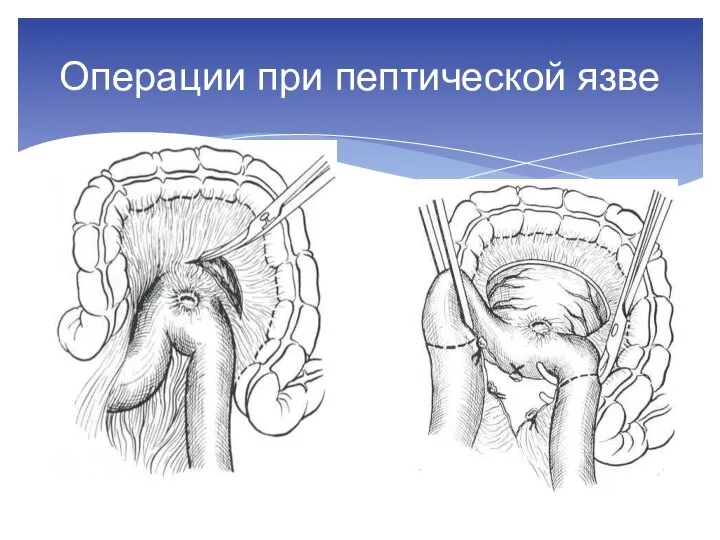 Операции при пептической язве