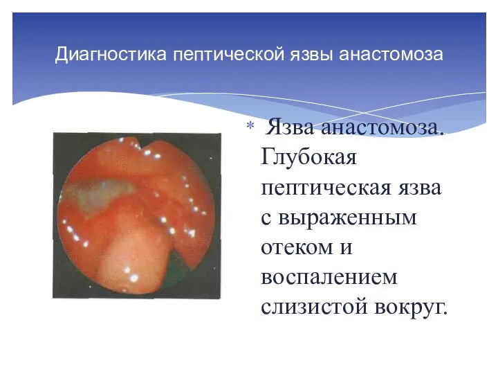 Диагностика пептической язвы анастомоза Язва анастомоза. Глубокая пептическая язва с выраженным отеком и воспалением слизистой вокруг.