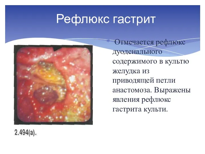 Рефлюкс гастрит Отмечается рефлюкс дуоденального содержимого в культю желудка из приводящей