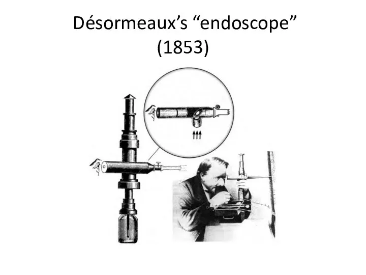 Désormeaux’s “endoscope” (1853)