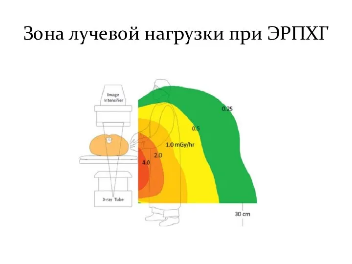 Зона лучевой нагрузки при ЭРПХГ