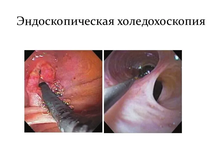 Эндоскопическая холедохоскопия