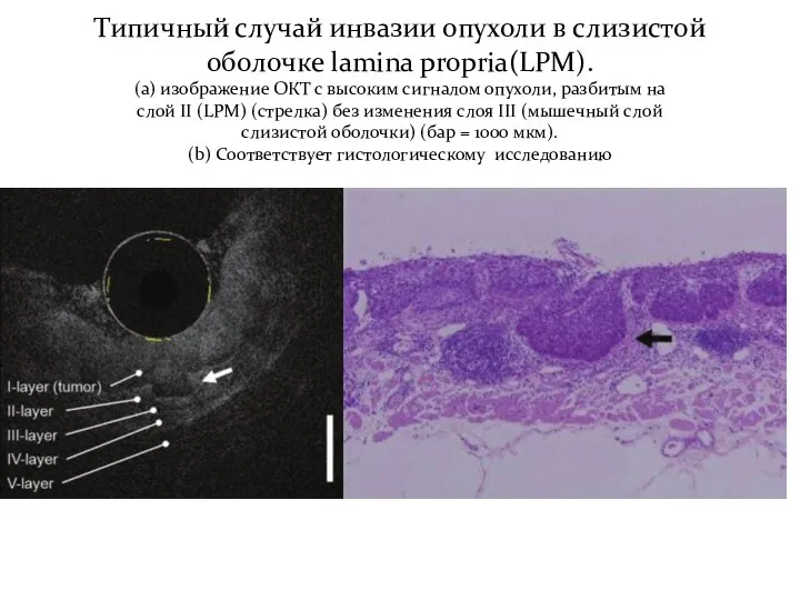 Типичный случай инвазии опухоли в слизистой оболочке lamina propria(LPM). (a) изображение
