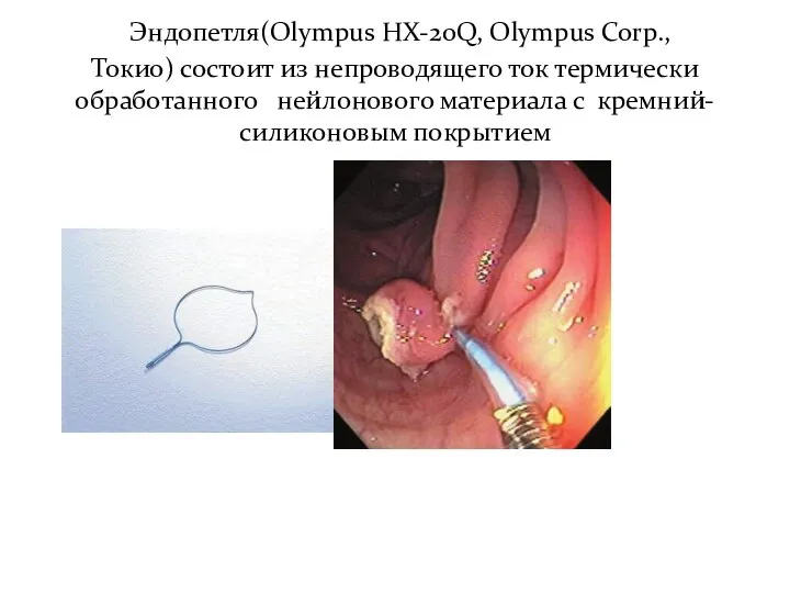 Эндопетля(Olympus HX-20Q, Olympus Corp., Токио) состоит из непроводящего ток термически обработанного нейлонового материала с кремний-силиконовым покрытием