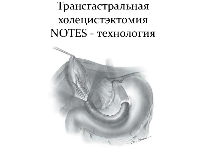 Трансгастральная холецистэктомия NOTES - технология