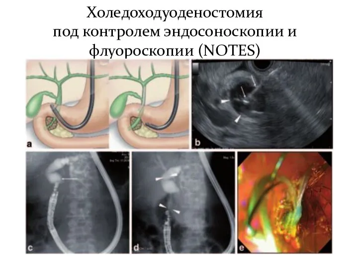 Холедоходуоденостомия под контролем эндосоноскопии и флуороскопии (NOTES)