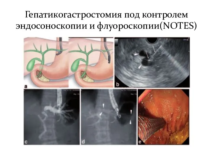 Гепатикогастростомия под контролем эндосоноскопии и флуороскопии(NOTES)