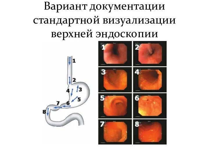 Вариант документации стандартной визуализации верхней эндоскопии