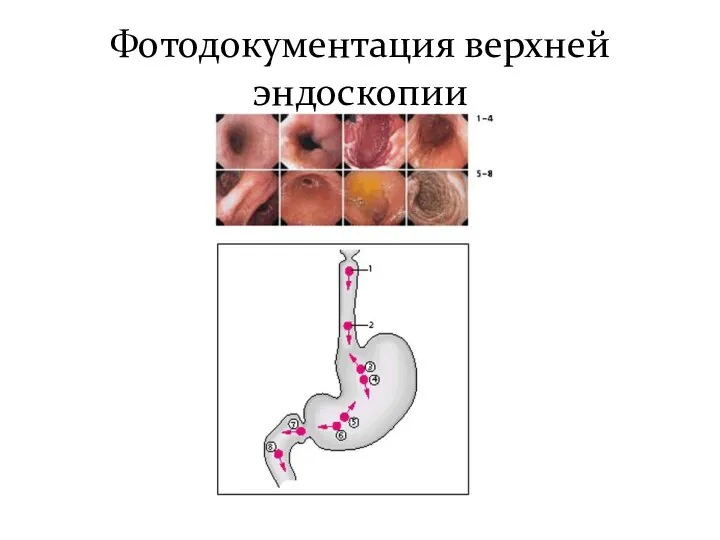 Фотодокументация верхней эндоскопии