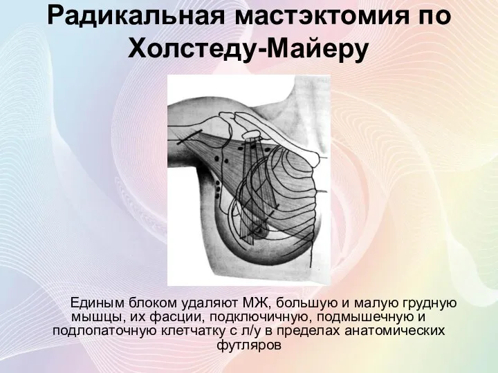 Радикальная мастэктомия по Холстеду-Майеру Единым блоком удаляют МЖ, большую и малую