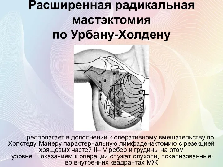 Расширенная радикальная мастэктомия по Урбану-Холдену Предполагает в дополнении к оперативному вмешательству