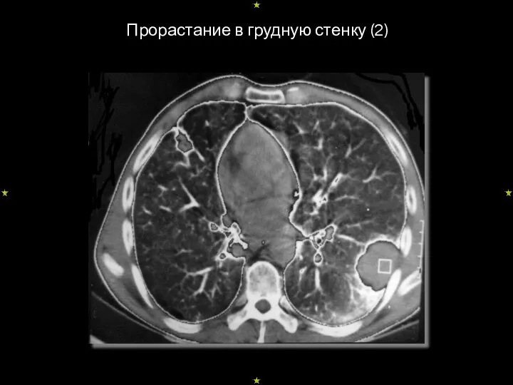 Прорастание в грудную стенку (2)