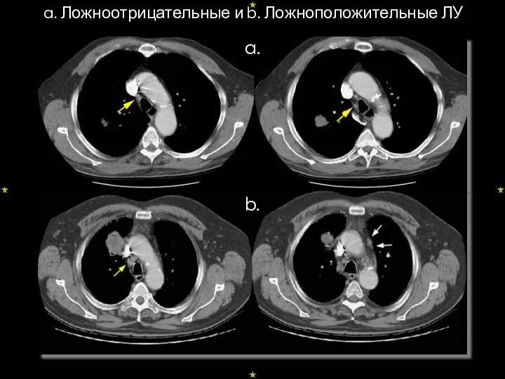 a. Ложноотрицательные и b. Ложноположительные ЛУ a. b.